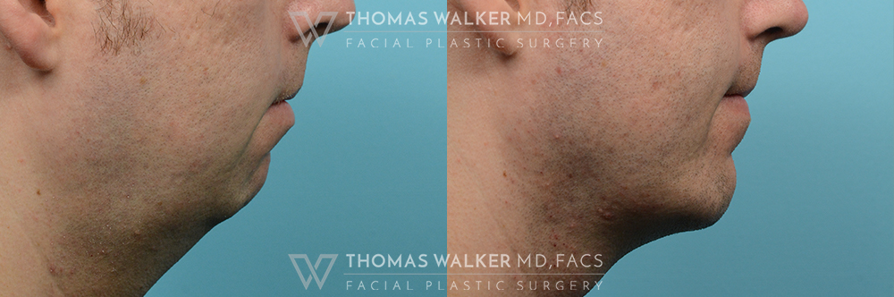 walker-gallery-Neck-Lipo-case100-1