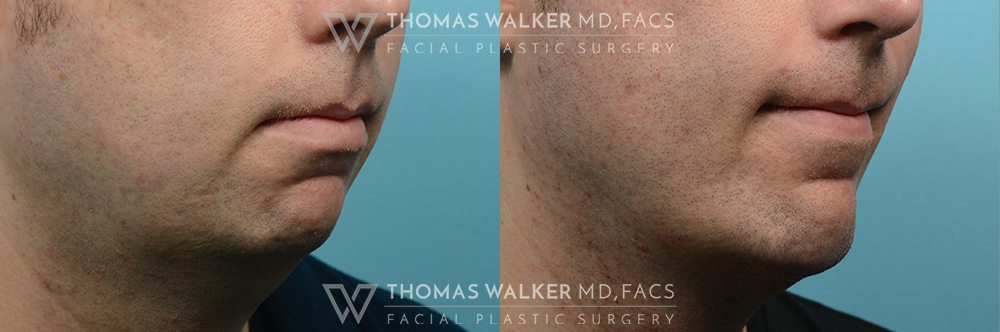 walker-gallery-Neck-Lipo-case100-2