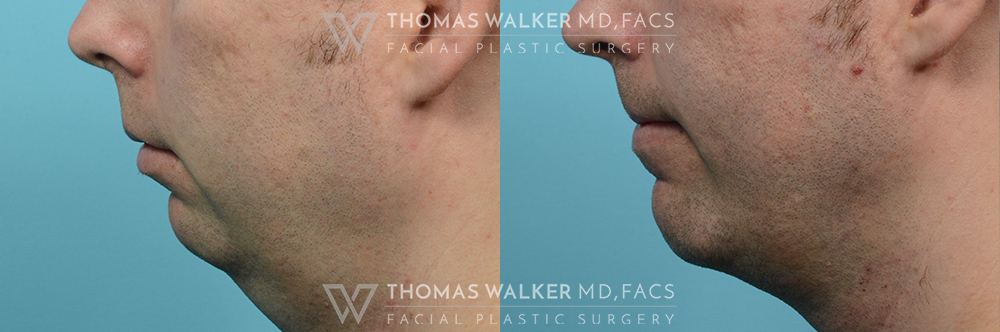 walker-gallery-Neck-Lipo-case100-3