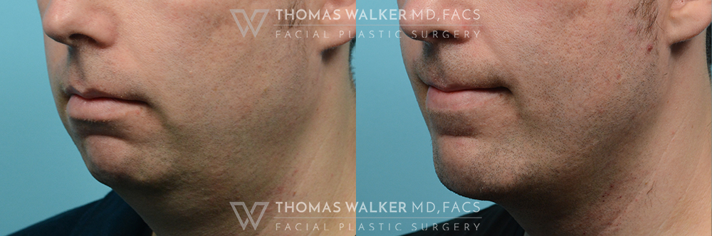 walker-gallery-Neck-Lipo-case100-4