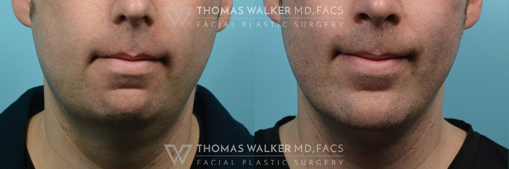 walker-gallery-Neck-Lipo-case100-5