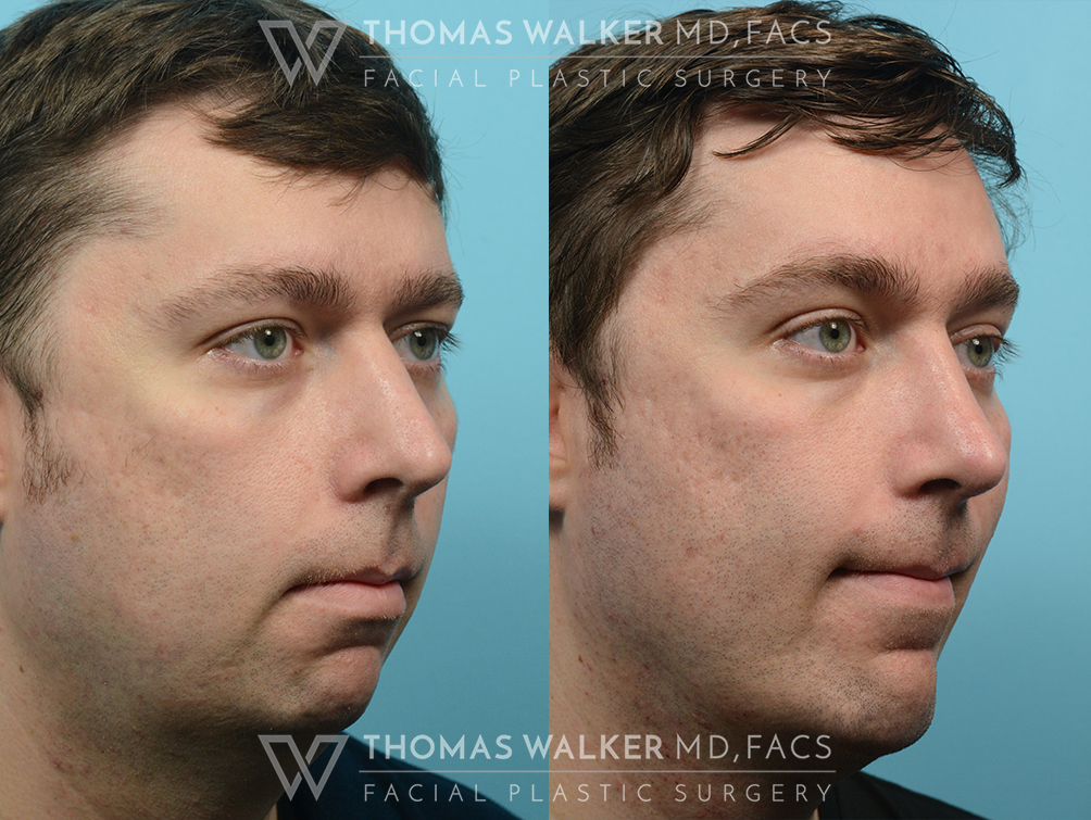 walker-gallery-rhinoplasty-case100-2