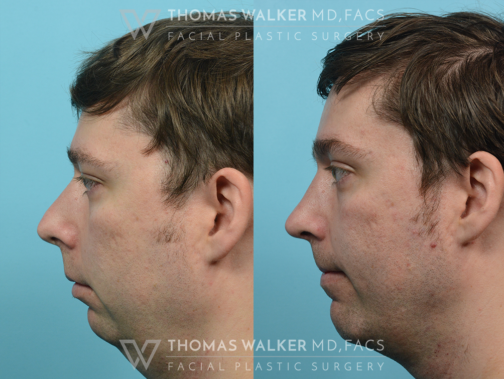 walker-gallery-rhinoplasty-case100-3