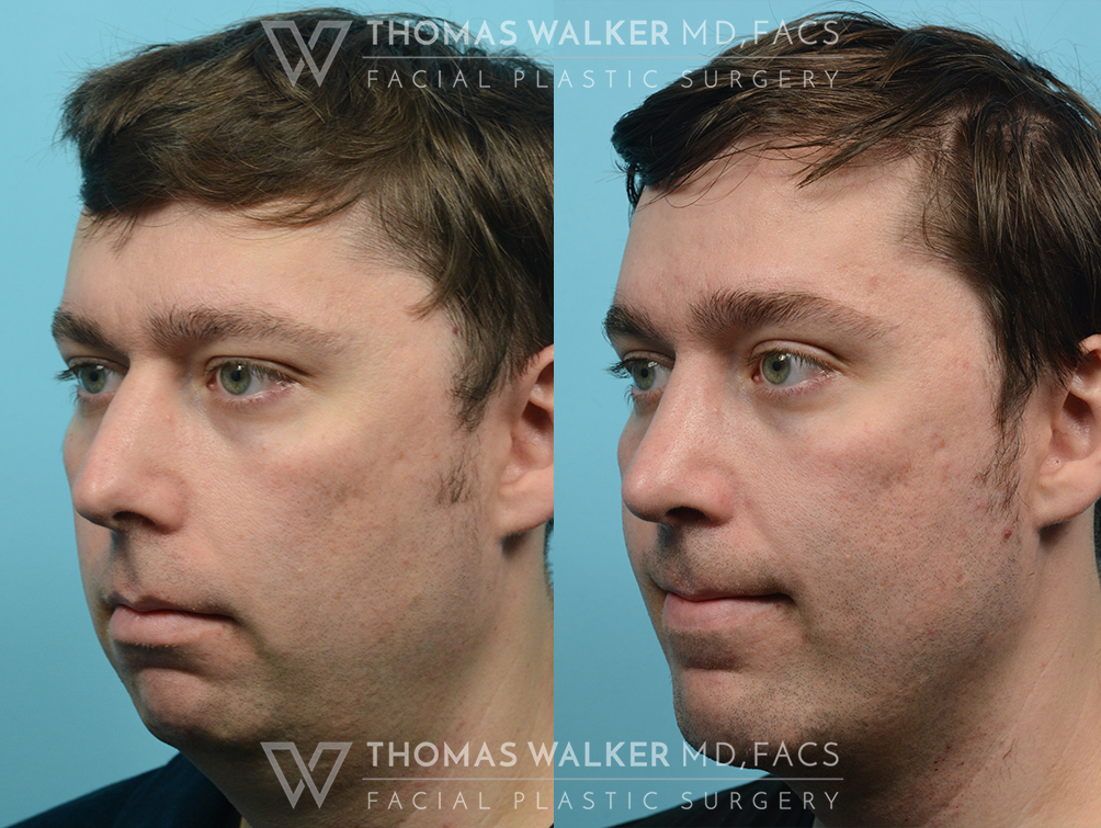 walker-gallery-rhinoplasty-case100-4