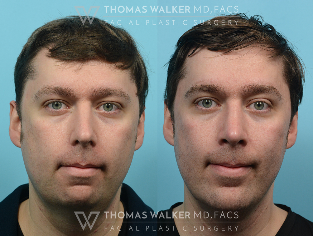 walker-gallery-rhinoplasty-case100-5