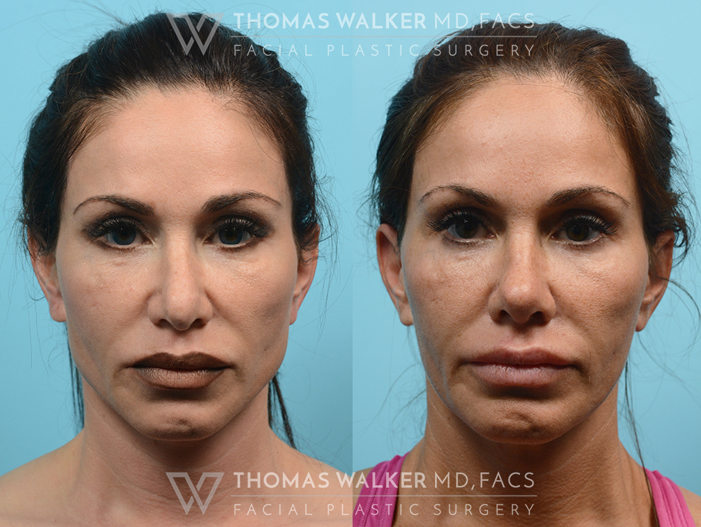 walker-gallery-rhinoplasty-case102-1