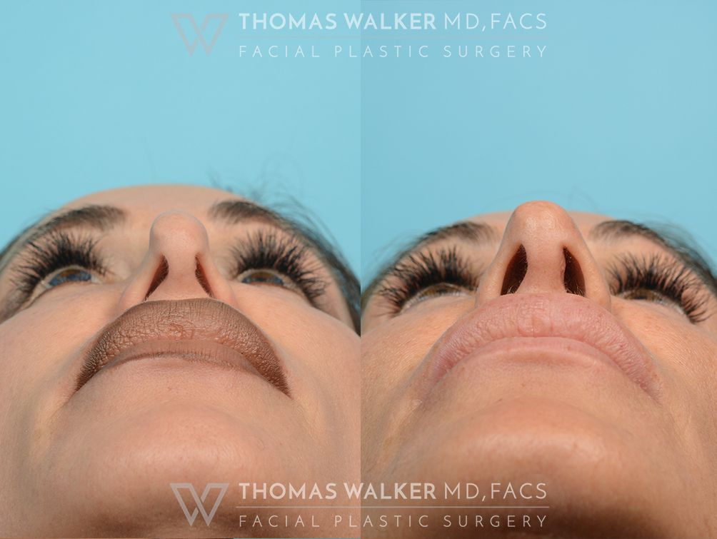 walker-gallery-rhinoplasty-case102-2