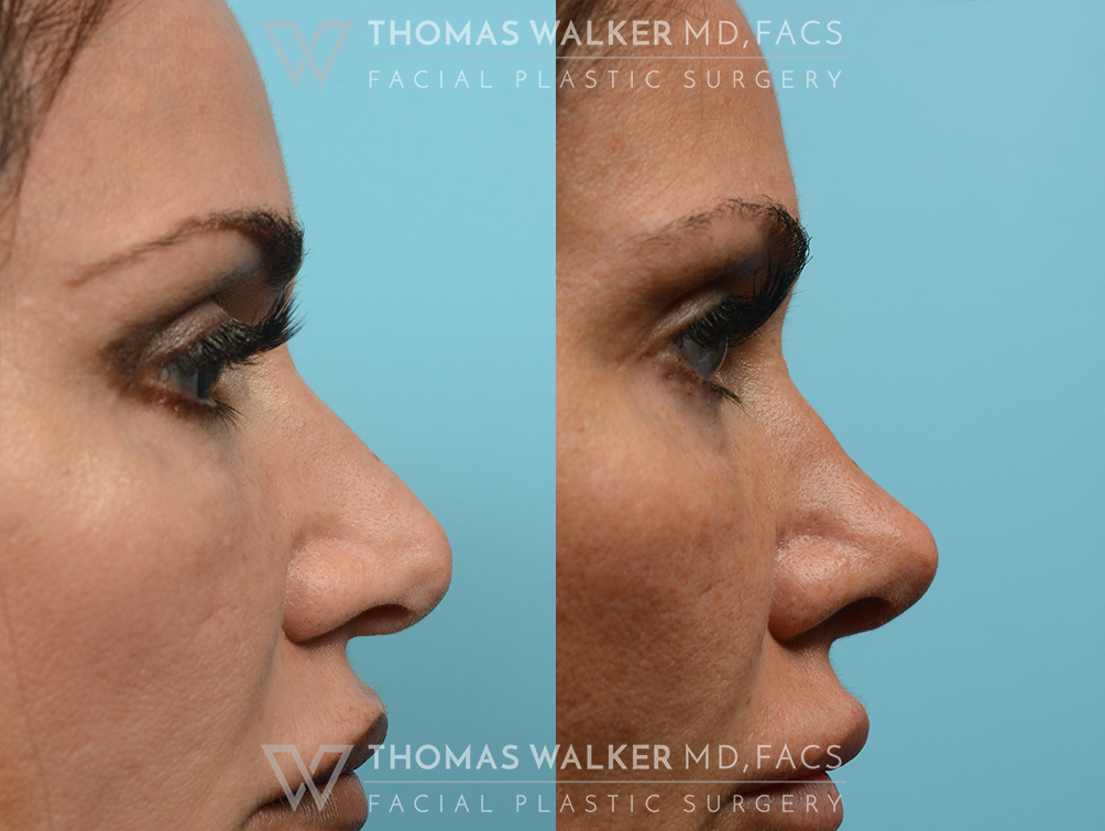 walker-gallery-rhinoplasty-case102-3