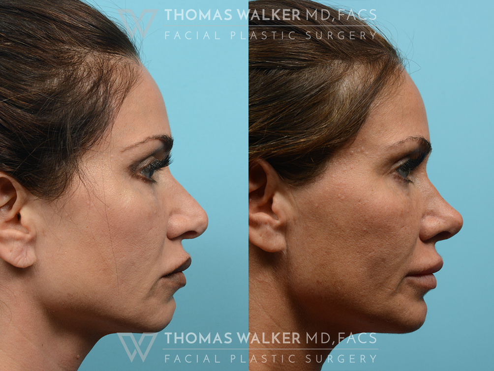 walker-gallery-rhinoplasty-case102-6