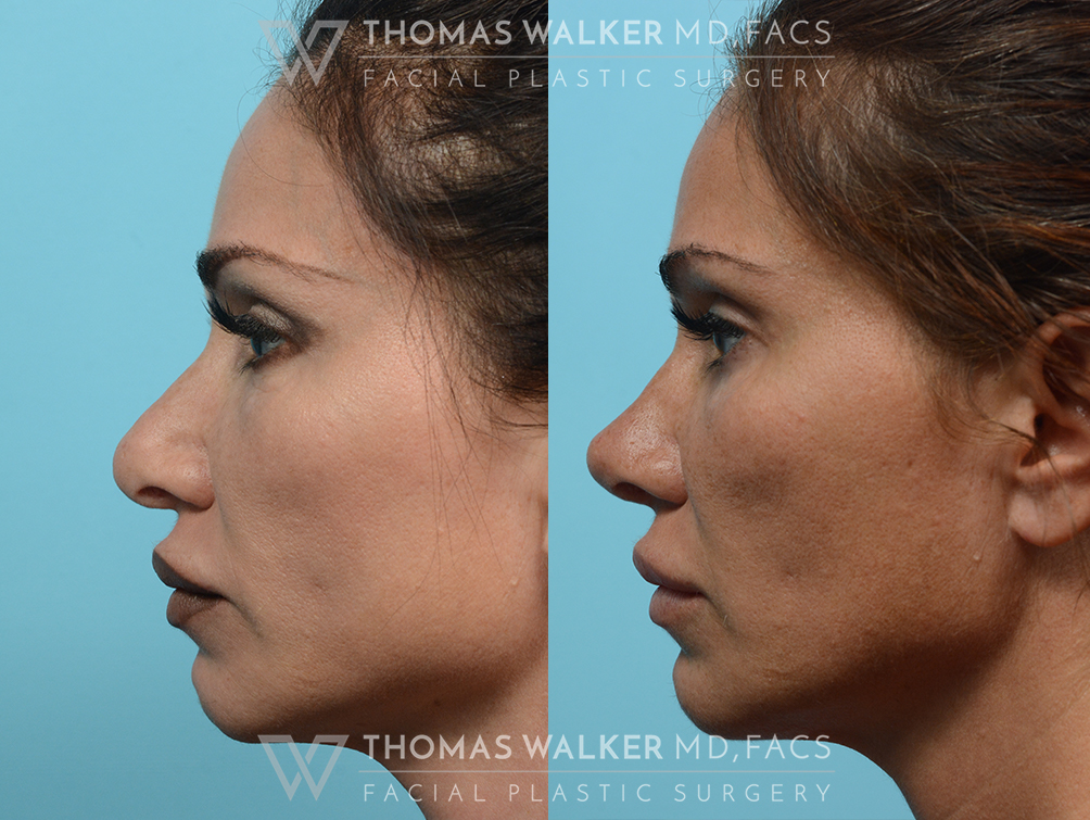 walker-gallery-rhinoplasty-case102-8