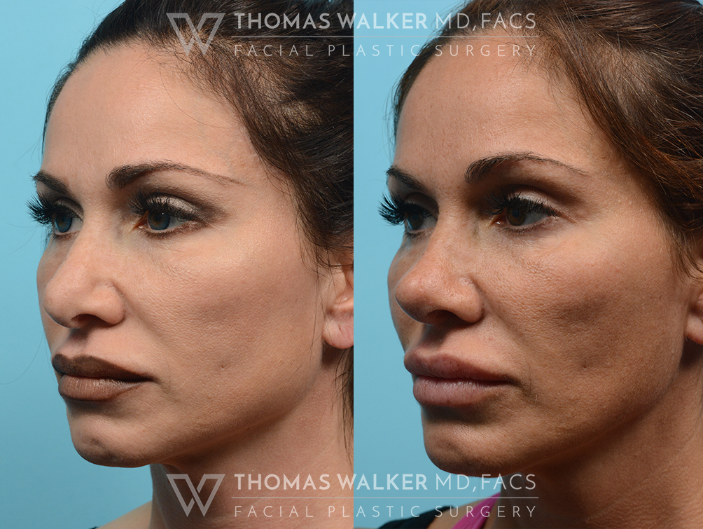 walker-gallery-rhinoplasty-case102-9