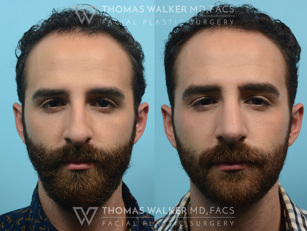 walker-gallery-septo-rhinoplasty-case103-1
