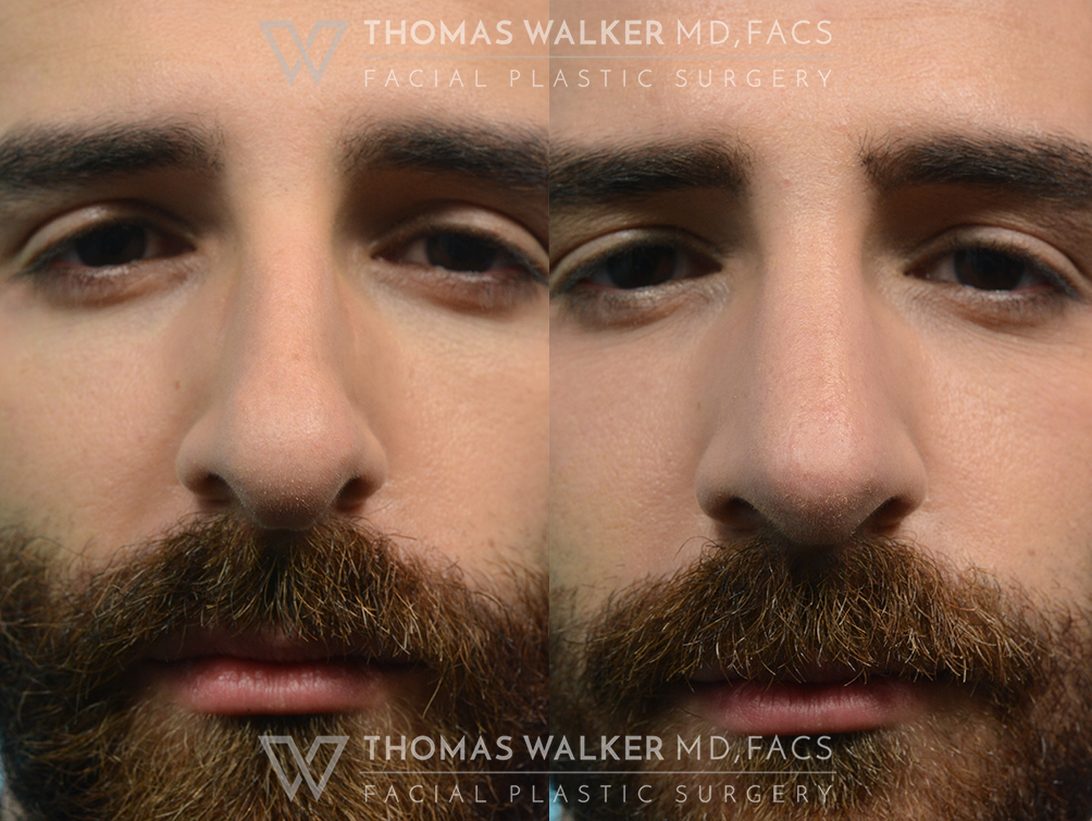 walker-gallery-septo-rhinoplasty-case103-10