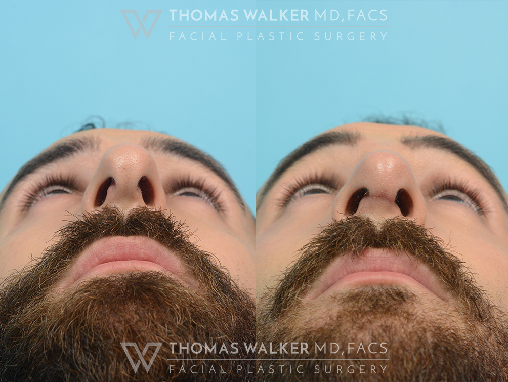 walker-gallery-septo-rhinoplasty-case103-11