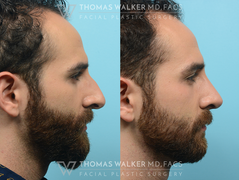 walker-gallery-septo-rhinoplasty-case103-2