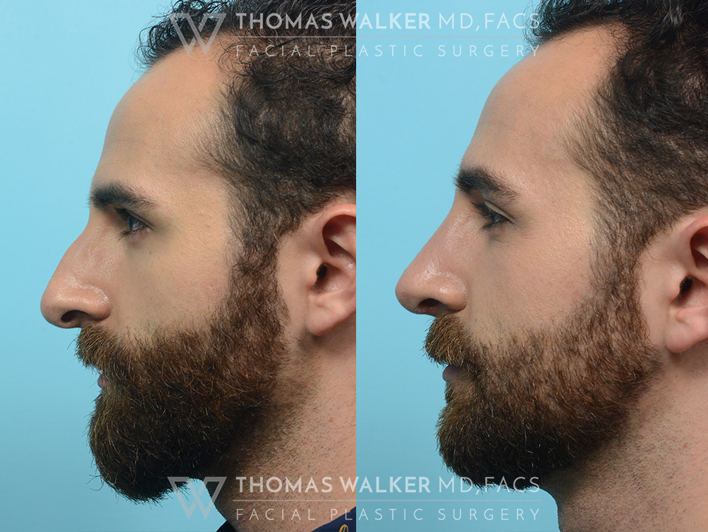 walker-gallery-septo-rhinoplasty-case103-4