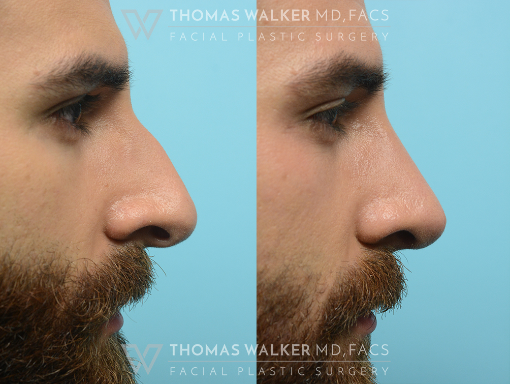 walker-gallery-septo-rhinoplasty-case103-6