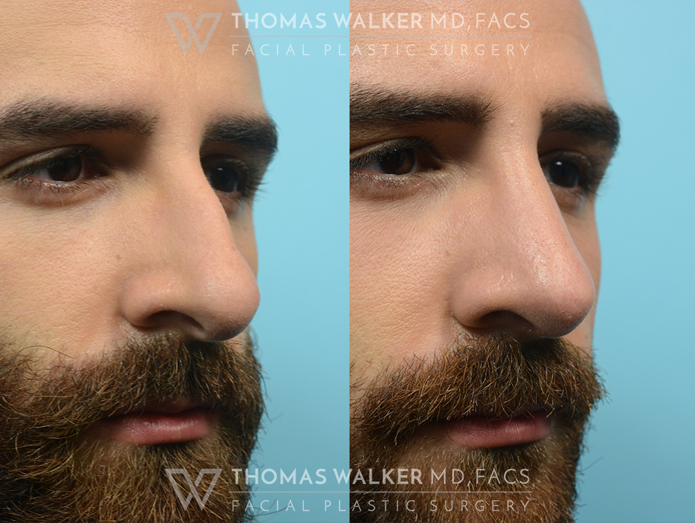 walker-gallery-septo-rhinoplasty-case103-7