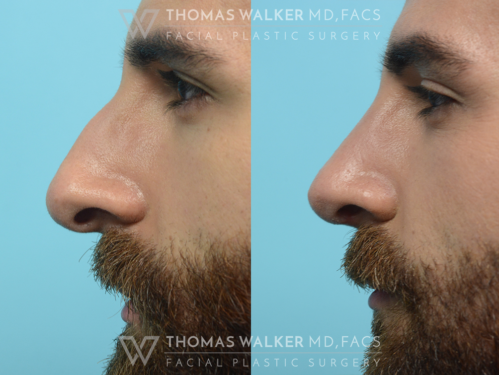 walker-gallery-septo-rhinoplasty-case103-8