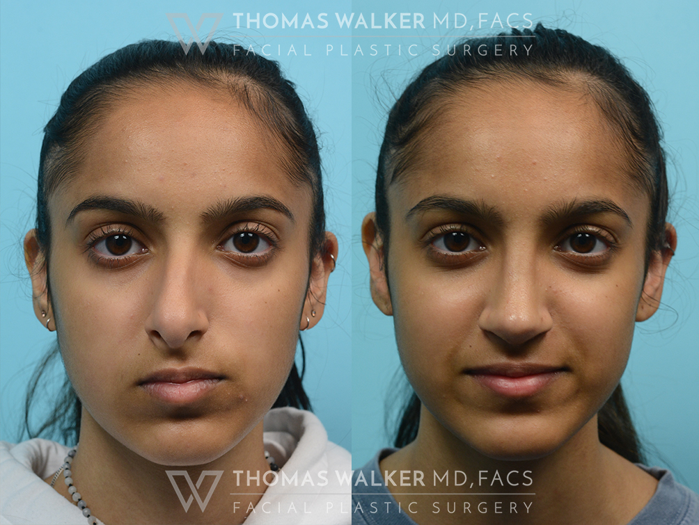 walker-gallery-septo-rhinoplasty-case104-1