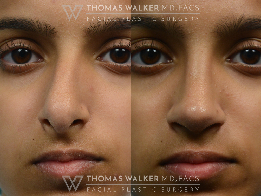 walker-gallery-septo-rhinoplasty-case104-10