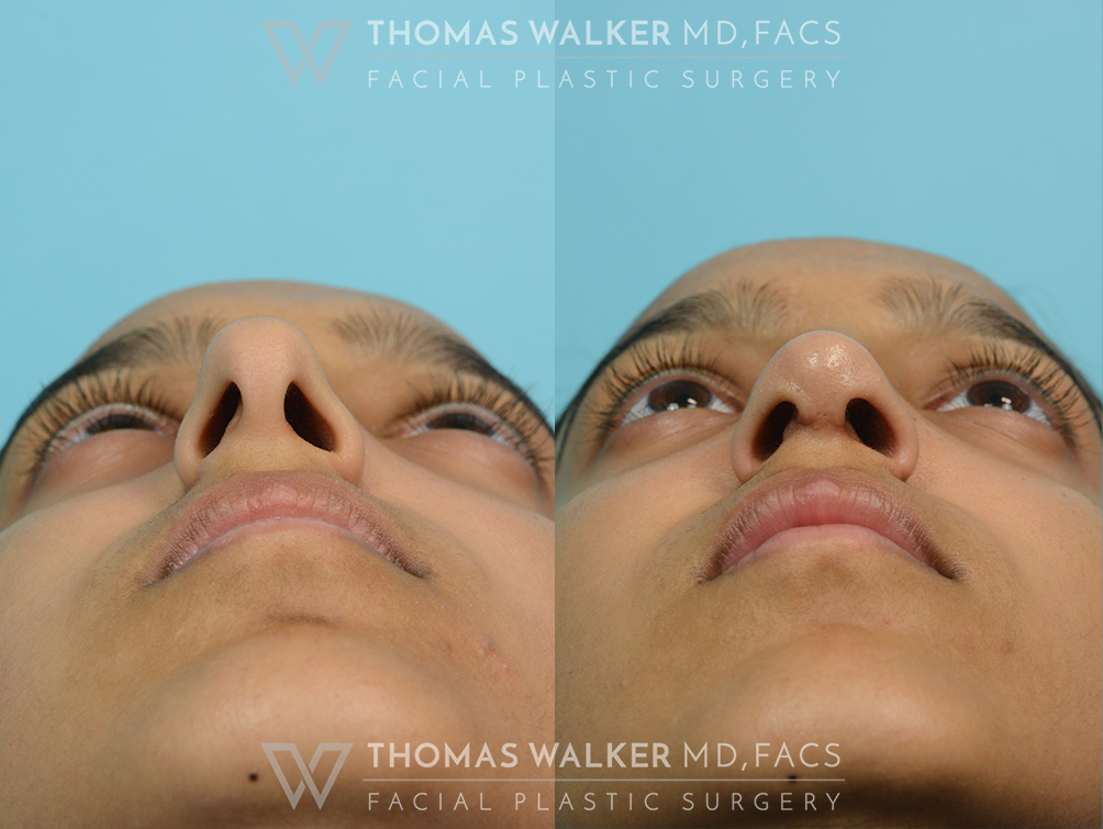 walker-gallery-septo-rhinoplasty-case104-11