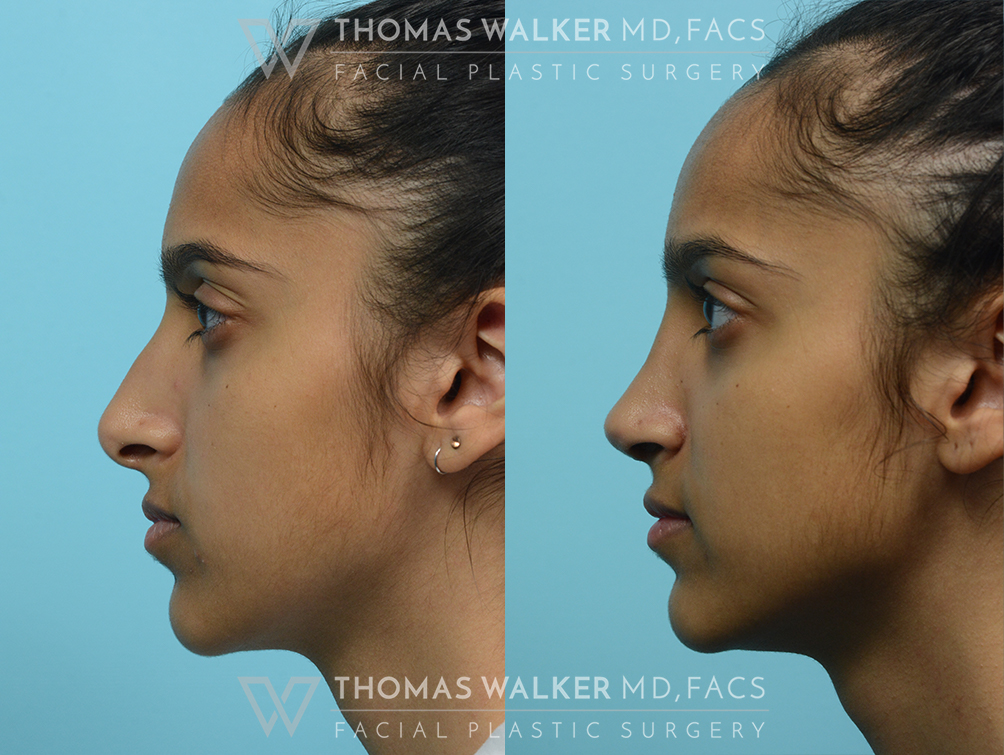 walker-gallery-septo-rhinoplasty-case104-4