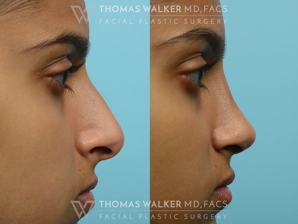 walker-gallery-septo-rhinoplasty-case104-6