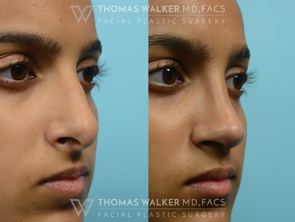 walker-gallery-septo-rhinoplasty-case104-7