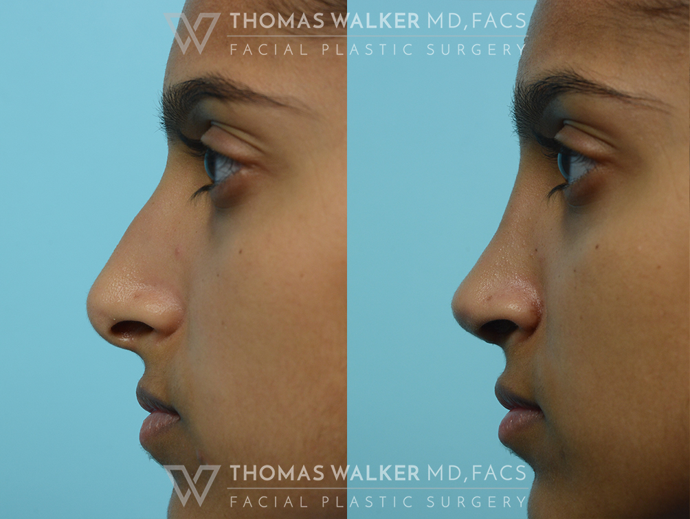 walker-gallery-septo-rhinoplasty-case104-8
