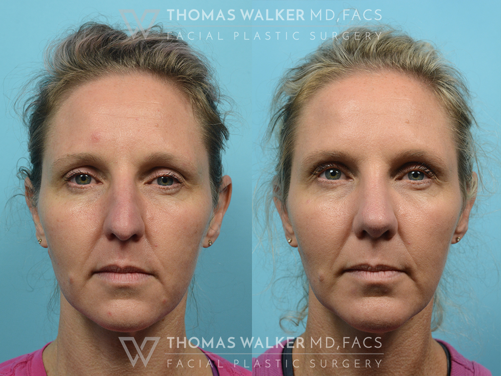 walker-gallery-septo-rhinoplasty-case106-1