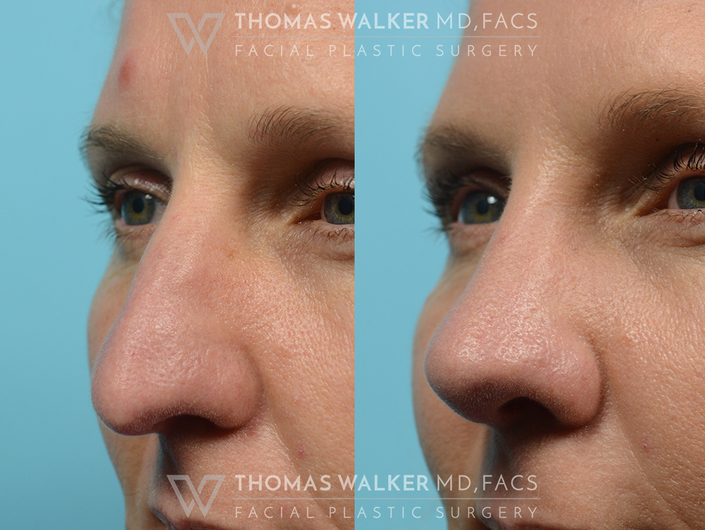 walker-gallery-septo-rhinoplasty-case106-10
