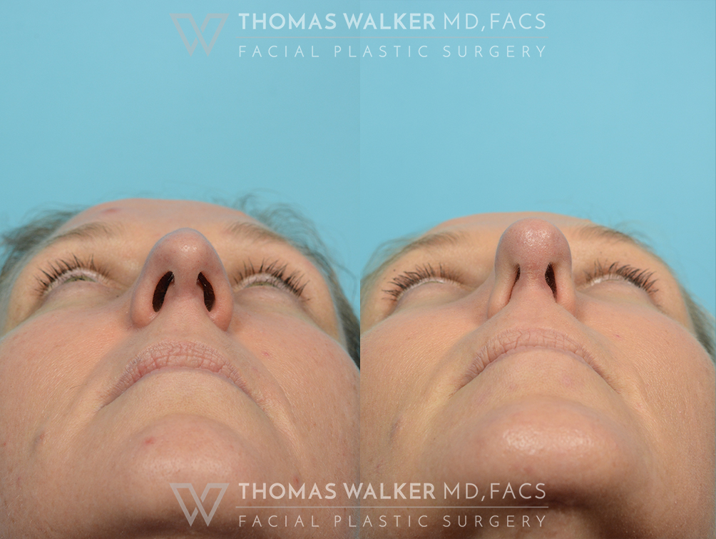 walker-gallery-septo-rhinoplasty-case106-11