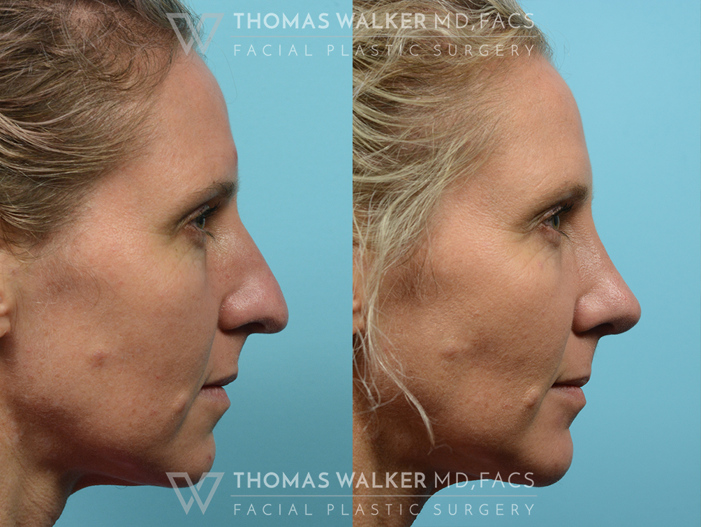 walker-gallery-septo-rhinoplasty-case106-2