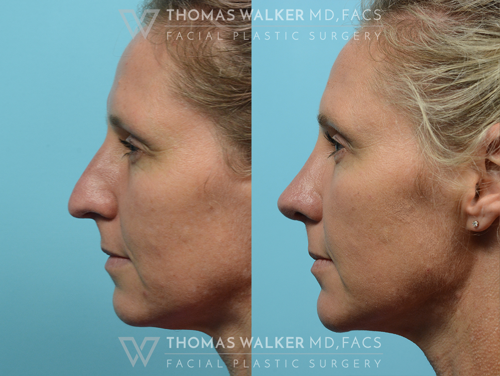 walker-gallery-septo-rhinoplasty-case106-4