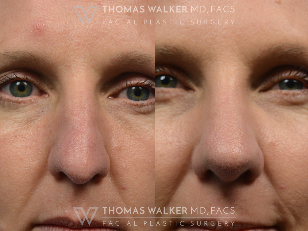 walker-gallery-septo-rhinoplasty-case106-6