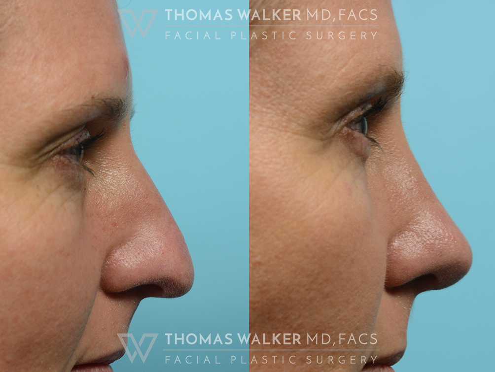 walker-gallery-septo-rhinoplasty-case106-7