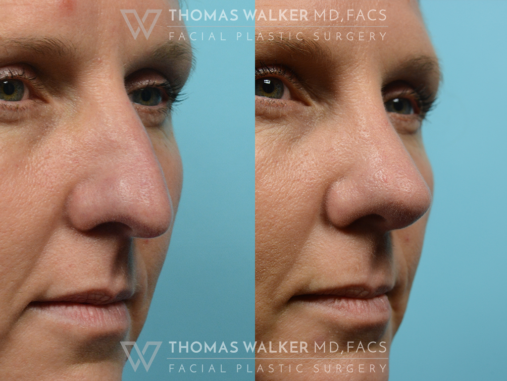 walker-gallery-septo-rhinoplasty-case106-8