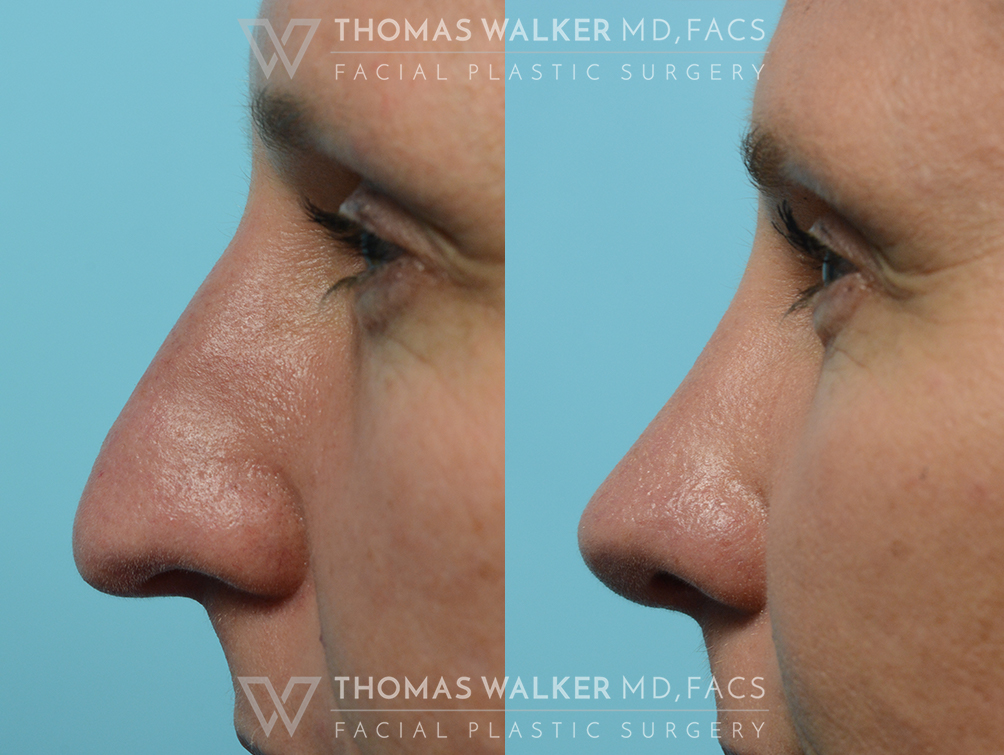 walker-gallery-septo-rhinoplasty-case106-9