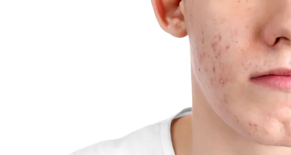 procedure-acne-scars