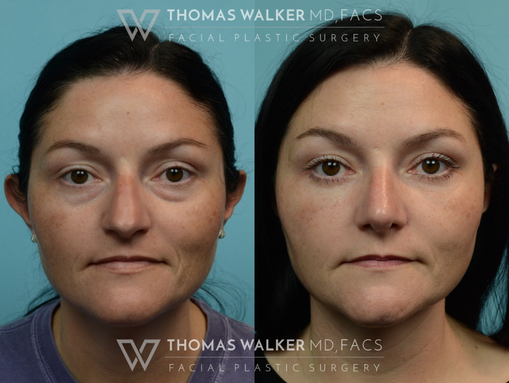 rhinoplasty female before and after photos