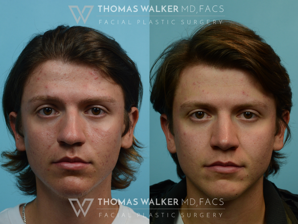 revision rhinoplasty male