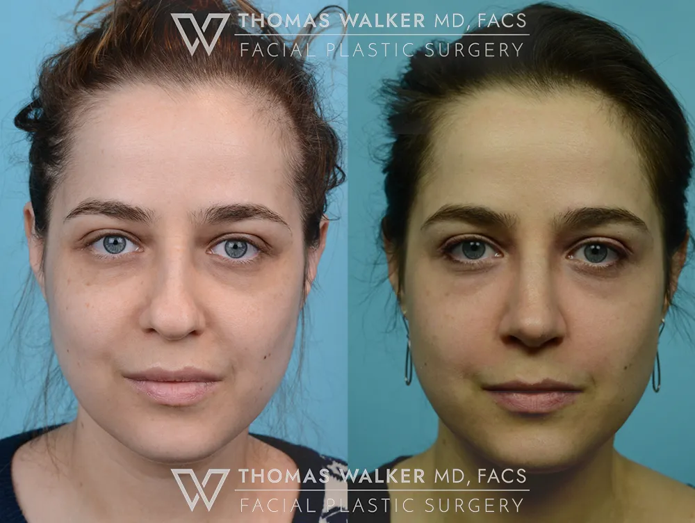 Septo-Rhinoplasty-01