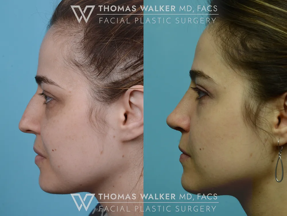 Septo-Rhinoplasty-03