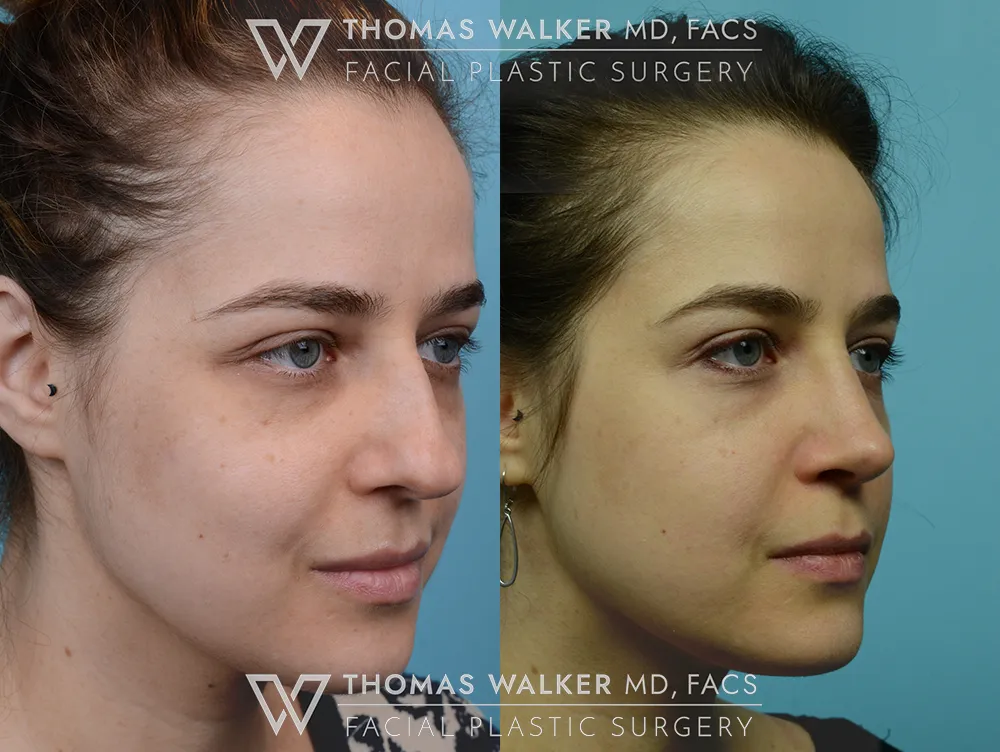 Septo-Rhinoplasty-04