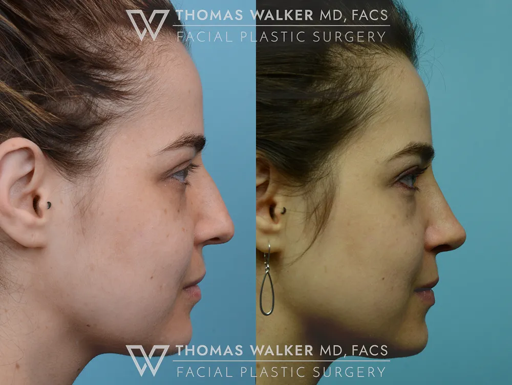 Septo-Rhinoplasty-05
